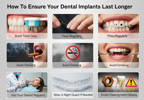 Ensure Your Dental Implants Last Longer