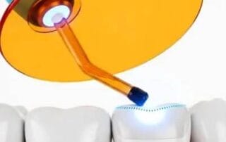 Murrieta tooth bonding