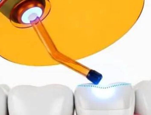 What is Tooth Bonding?