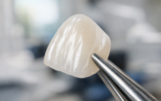 Cross-section diagram of dental veneer placement