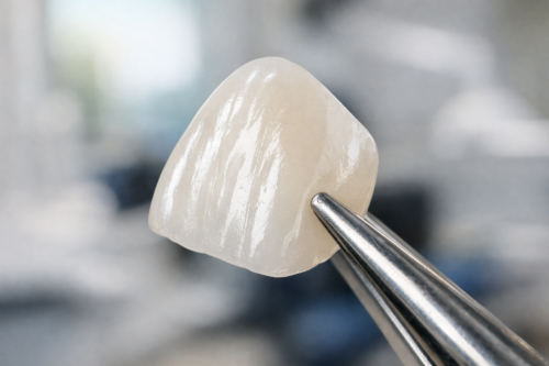 Cross-section diagram of dental veneer placement