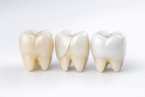 Tooth bonding veneer and crown comparison