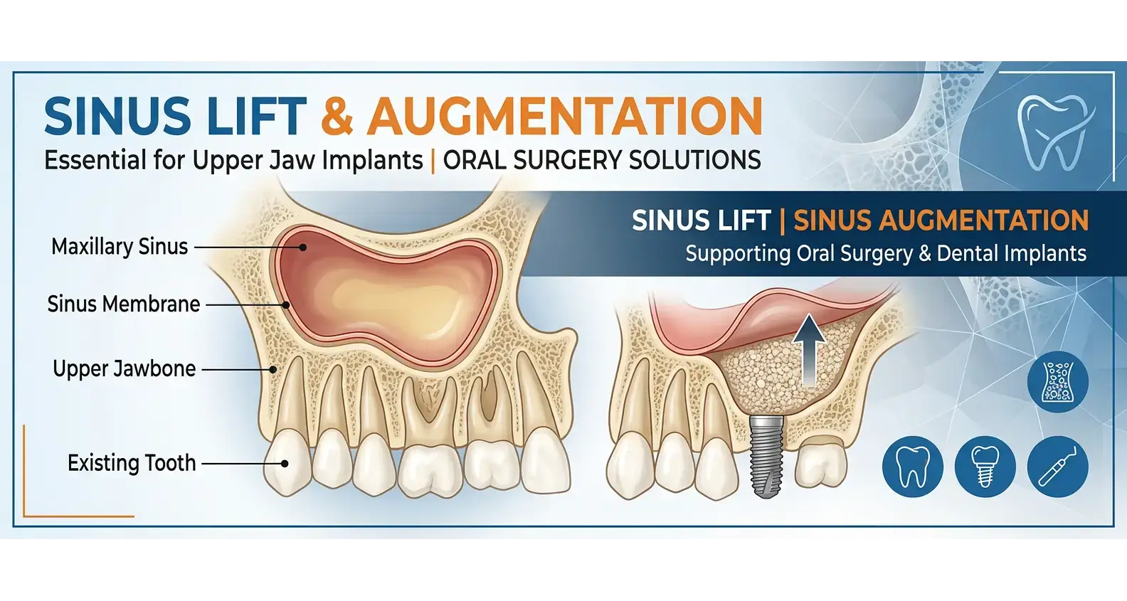 sinus lift