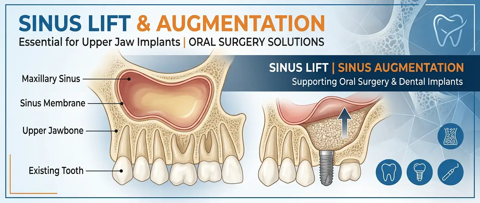Sinus lift and bone grafting for dental implants in Murrieta, CA at Promenade Dental Care