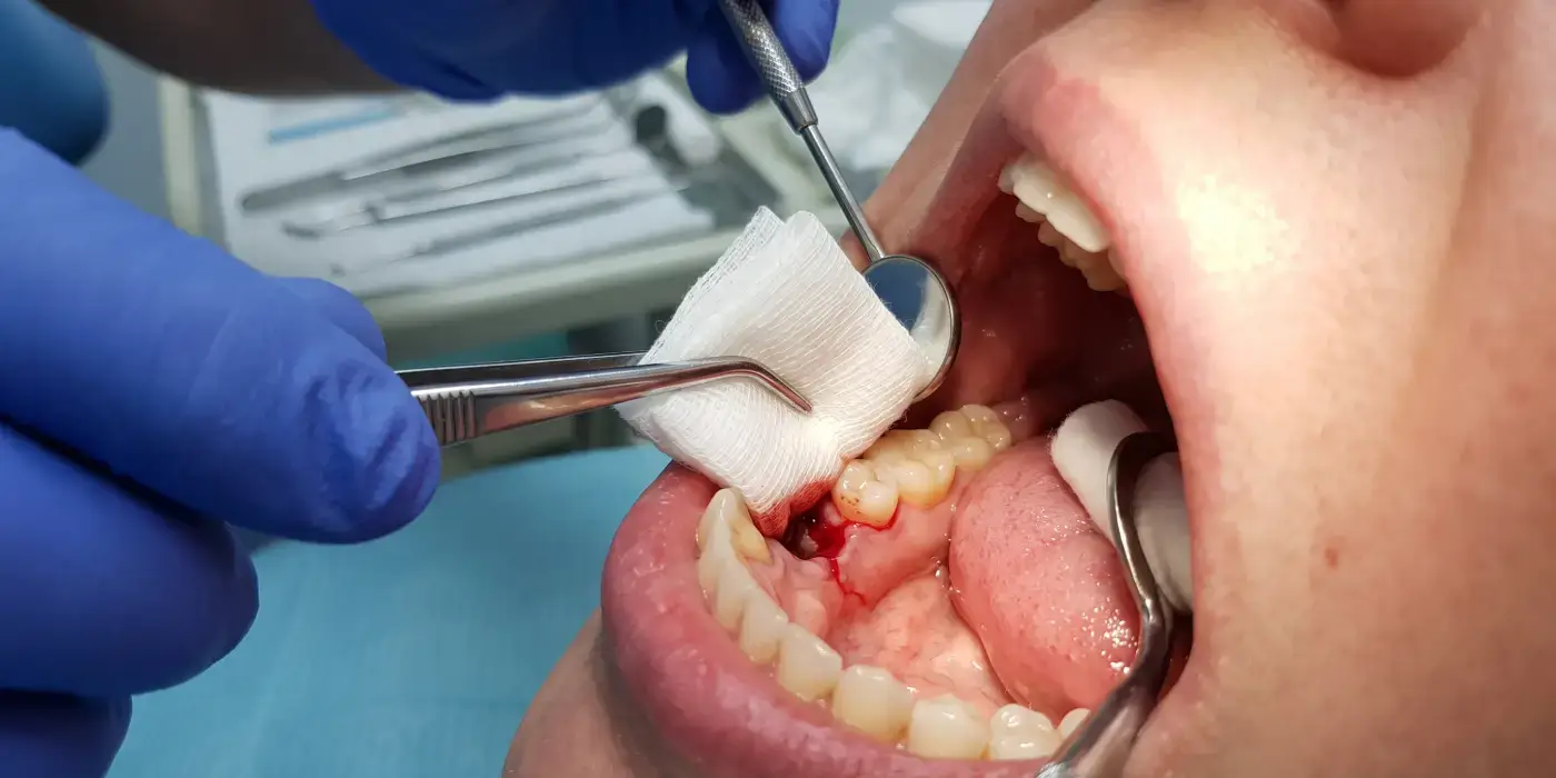 folded gauze pad being placed over a lower molar