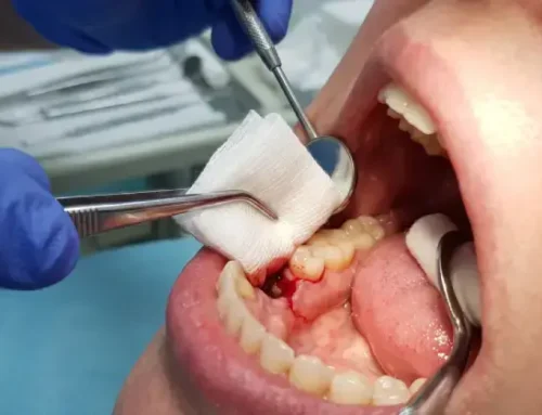 Bleeding After a Tooth Extraction: What’s Normal and How to Stop It