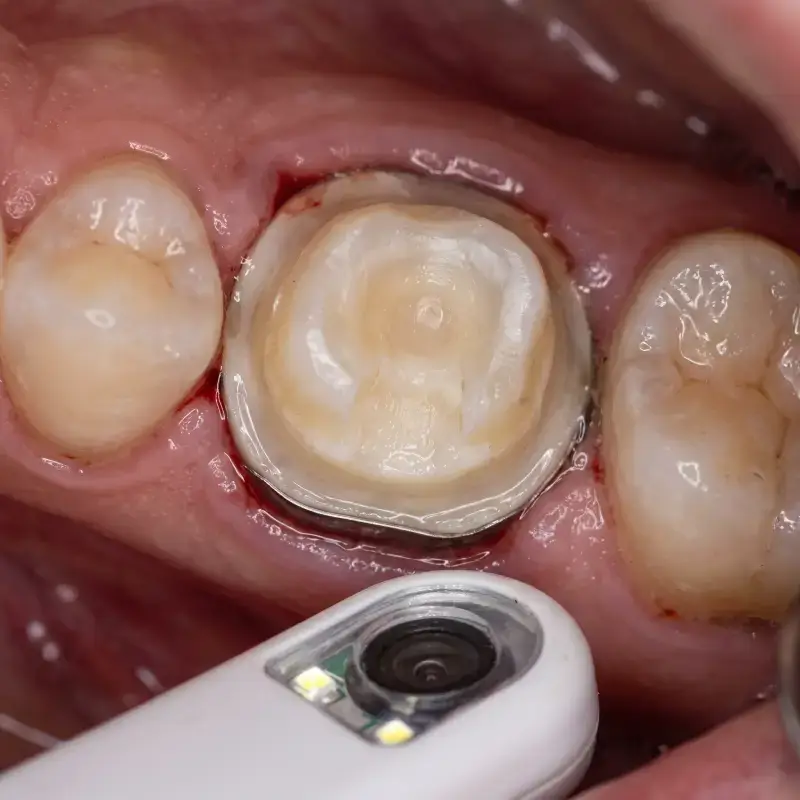 Intraoral view of a tooth after it has been drilled for a crown